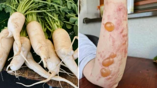 „Sklízela jsem zeleninu a&nbsp;skončila na kožním oddělení,“ uvádí zahradnice, kterou „popálila“ běžná kořenová zelenina