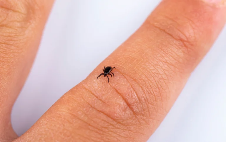 Jak správně vyndat klíště: Češi věří starým mýtům s&nbsp;mastmi a&nbsp;olejíčky. Správný postup je s&nbsp;pinzetou