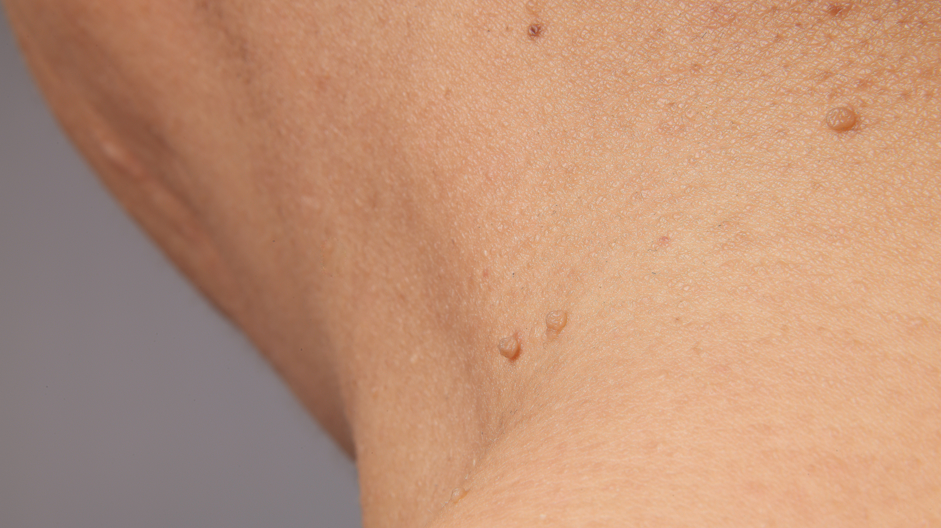 Kůže na krku a v podpaží s několika drobnými měkkými fibromy