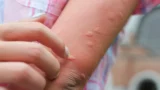 Budíte se v&nbsp;noci kvůli štípancům od komárů? Zbavíte se jich i&nbsp;bez silné chemie, největším nepřítelem je stojatá voda
